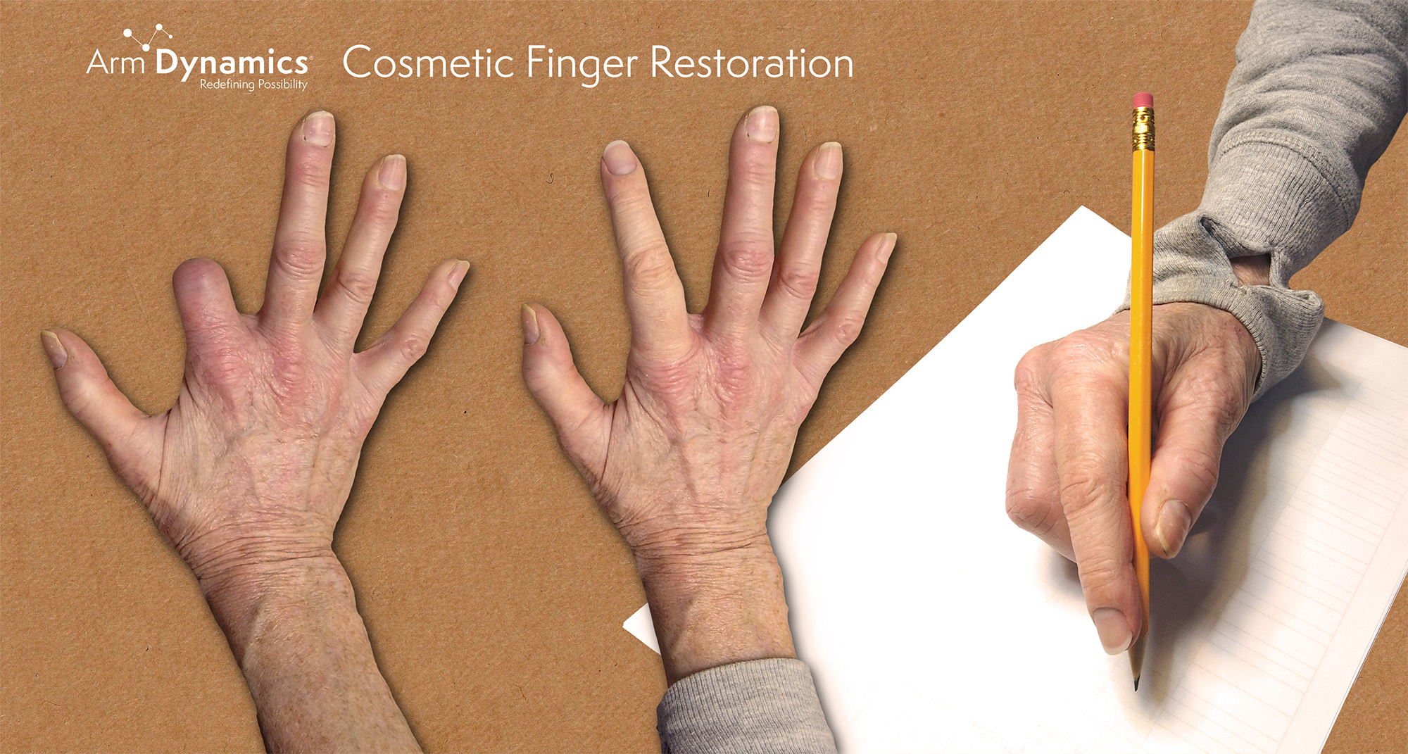 Cosmetic Finger Restoration - Janice Woods